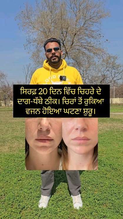 ਸਿਰਫ਼ 20 ਦਿਨ ਵਿੱਚ ਚਿਹਰੇ ਦੇ ਦਾਗ-ਧੱਬੇ ਠੀਕ। ਚਿਰਾਂ ਤੋਂ ਰੁਕਿਆ ਵਜਨ ਹੋਇਆ ਘਟਣਾ ਸ਼ੁਰੂ। Melasma reversal case